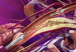 GORE Flow Reversal System Provides Neuroprotection During Carotid